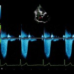 mlAlpha_Heart_CW_Doppler_Imaging_Cardiac