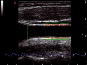 mlSevenCarotidArtery(RF-QIMT_QAS)_Vascular