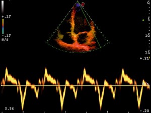 mlSevenHeart_TissueDopplerImaging(TVM)_Cardiology