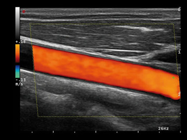 Carotid Artery (HD CFM Imaging) 