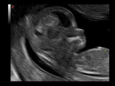 Fetus (XView - MView - TEI™Imaging) 