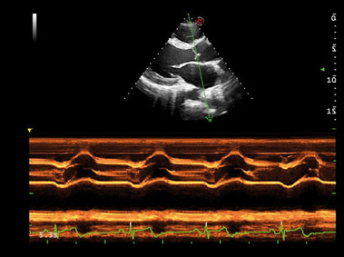 Heart (CMM Imaging) 